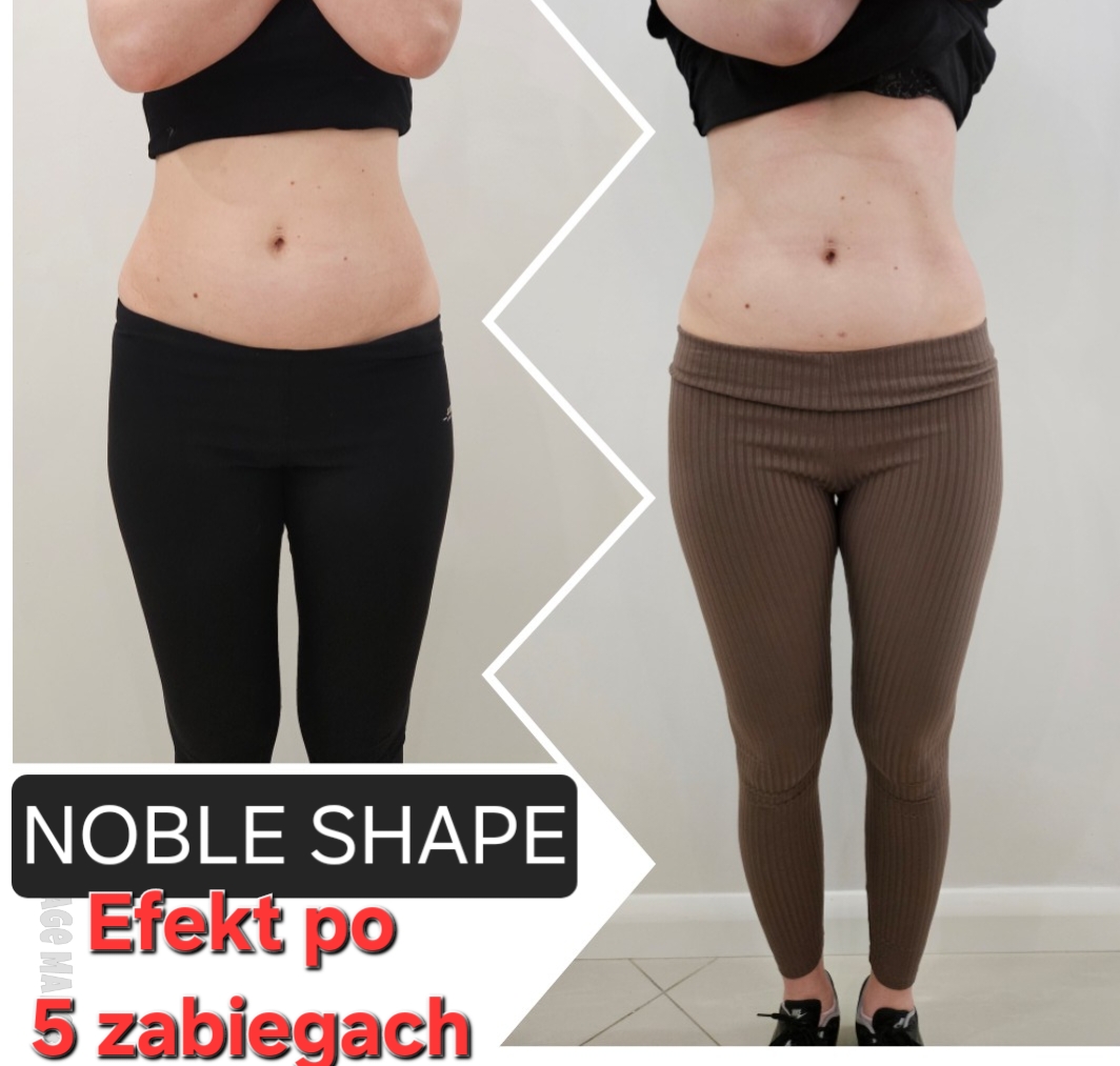Efekty zabiegu noble shape