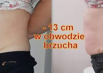 efekty zabiegu liposukcji 11