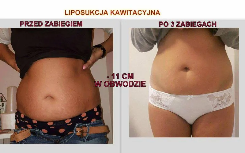 Efekty liposukcji kawitacyjnej